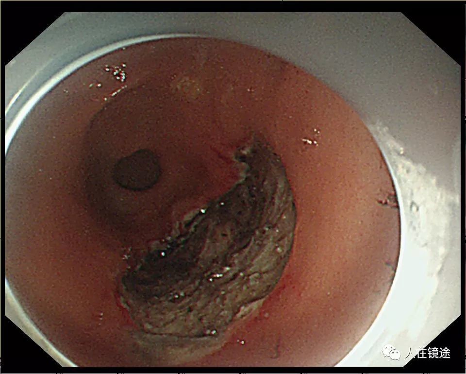 胃原位癌图片