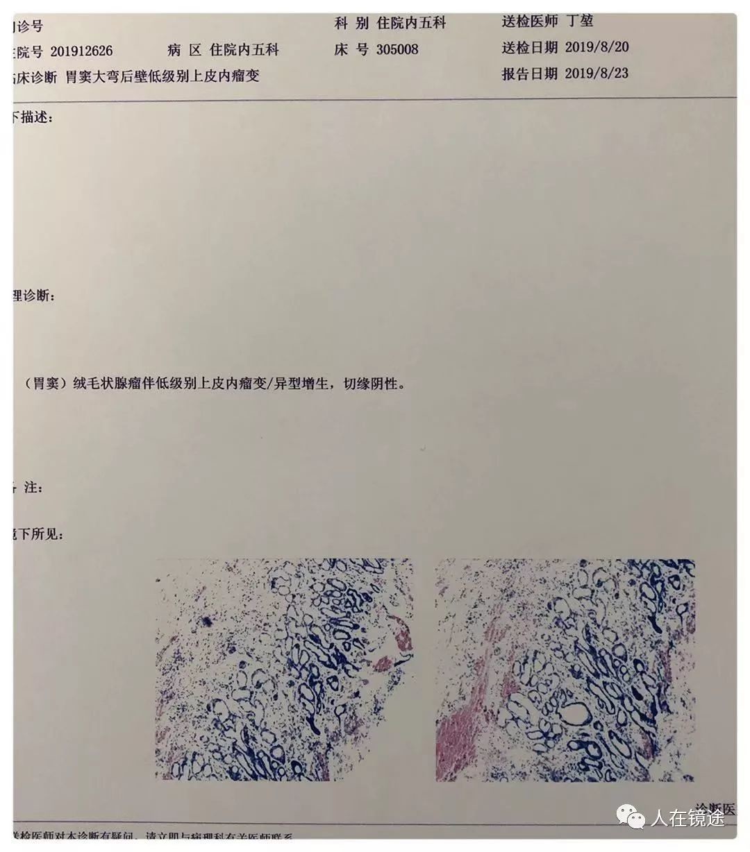 胃窦部癌前病变一例诊治分享