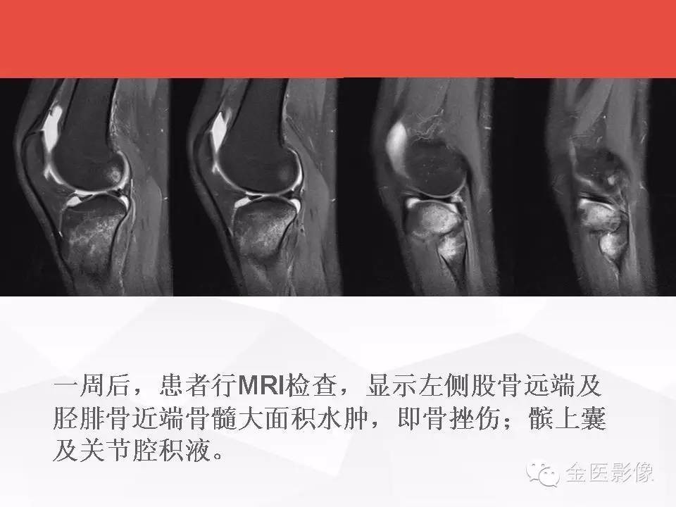 膝关节隐匿性骨折如何诊断 医学界 助力医生临床决策和职业成长