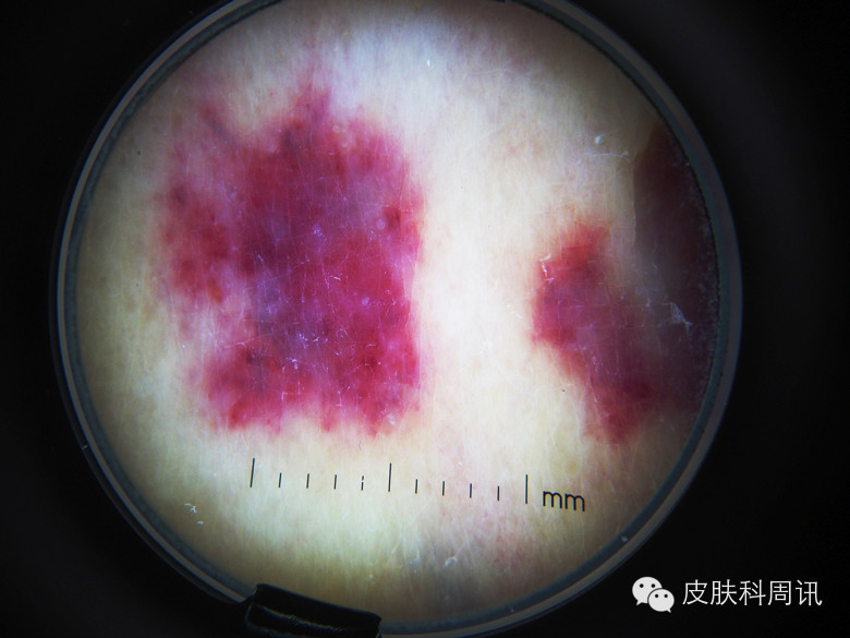 冻伤样kaposi肉瘤病案1例