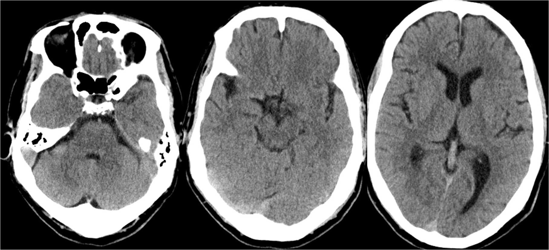 ▼7:22头ct》昏迷后行头mra检查.
