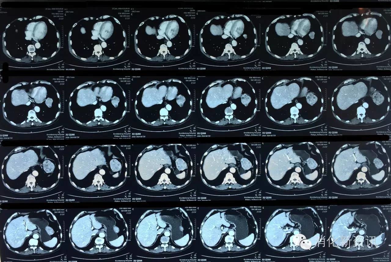 下面一張ct掃描的圖片,像素還給的比較大,專業人士可以放大看看,腫瘤