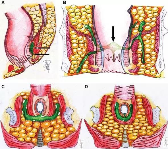 形成各种不同类型的高位复杂性肛瘘)因为hanley术式的手术切口较大