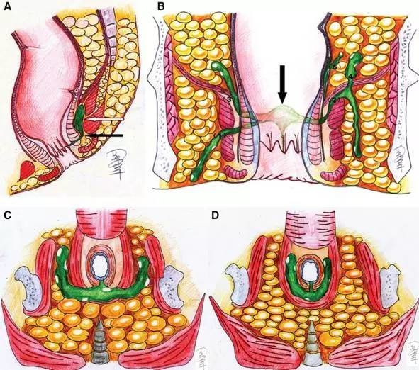 括约肌间瘘图片