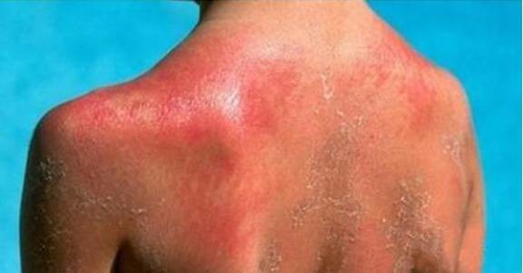 最凶皮肤杀手:痤疮&日光性皮炎_医学界-助力医生临床决策和职业成长