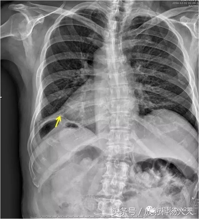 怀疑肋骨骨折 只看片子或只摸一摸都不可取 医学界 助力医生临床决策和职业成长