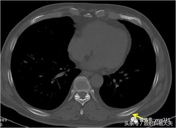 怀疑肋骨骨折 只看片子或只摸一摸都不可取 医学界 助力医生临床决策和职业成长
