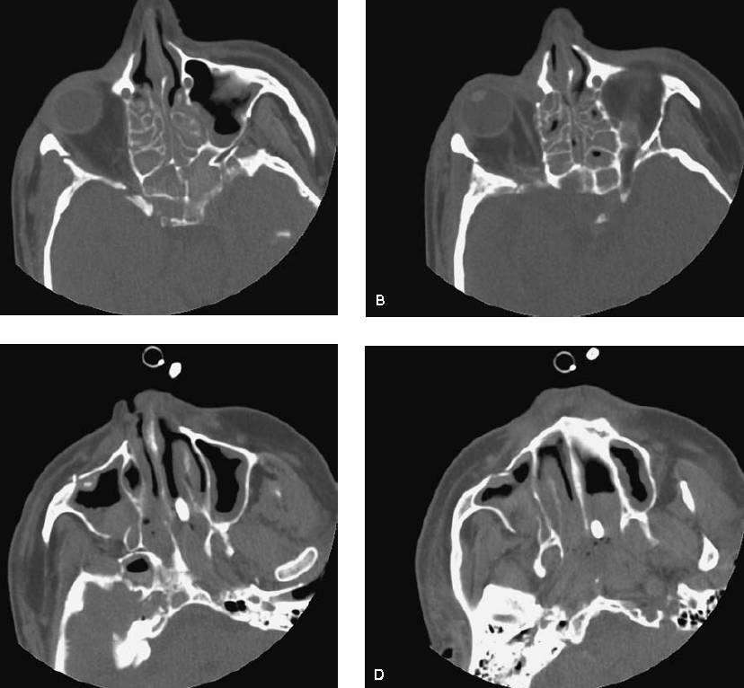 颧骨骨折 上颌骨骨折ct表现 医学界 助力医生临床决策和职业成长