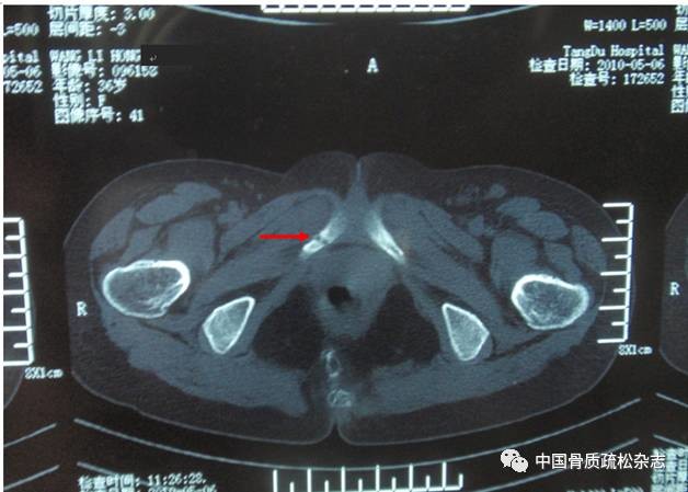 9例骨软化症临床误诊分析 医学界 助力医生临床决策和职业成长