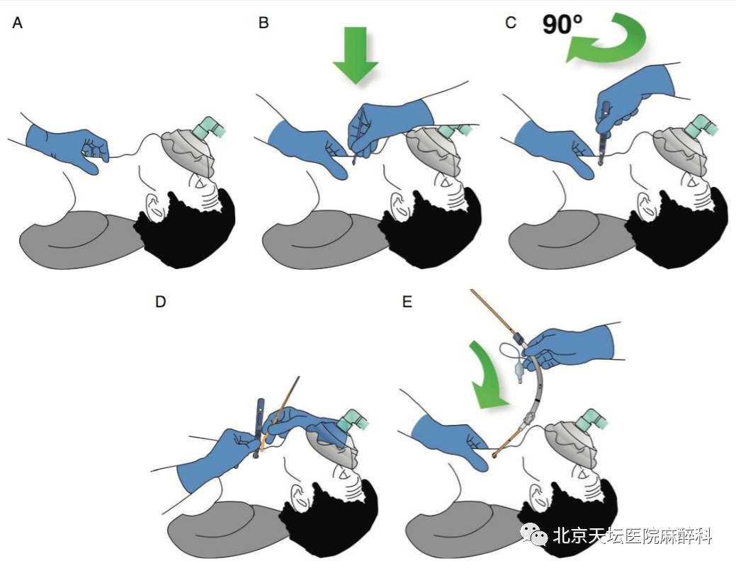 气管插管图片卡通图片