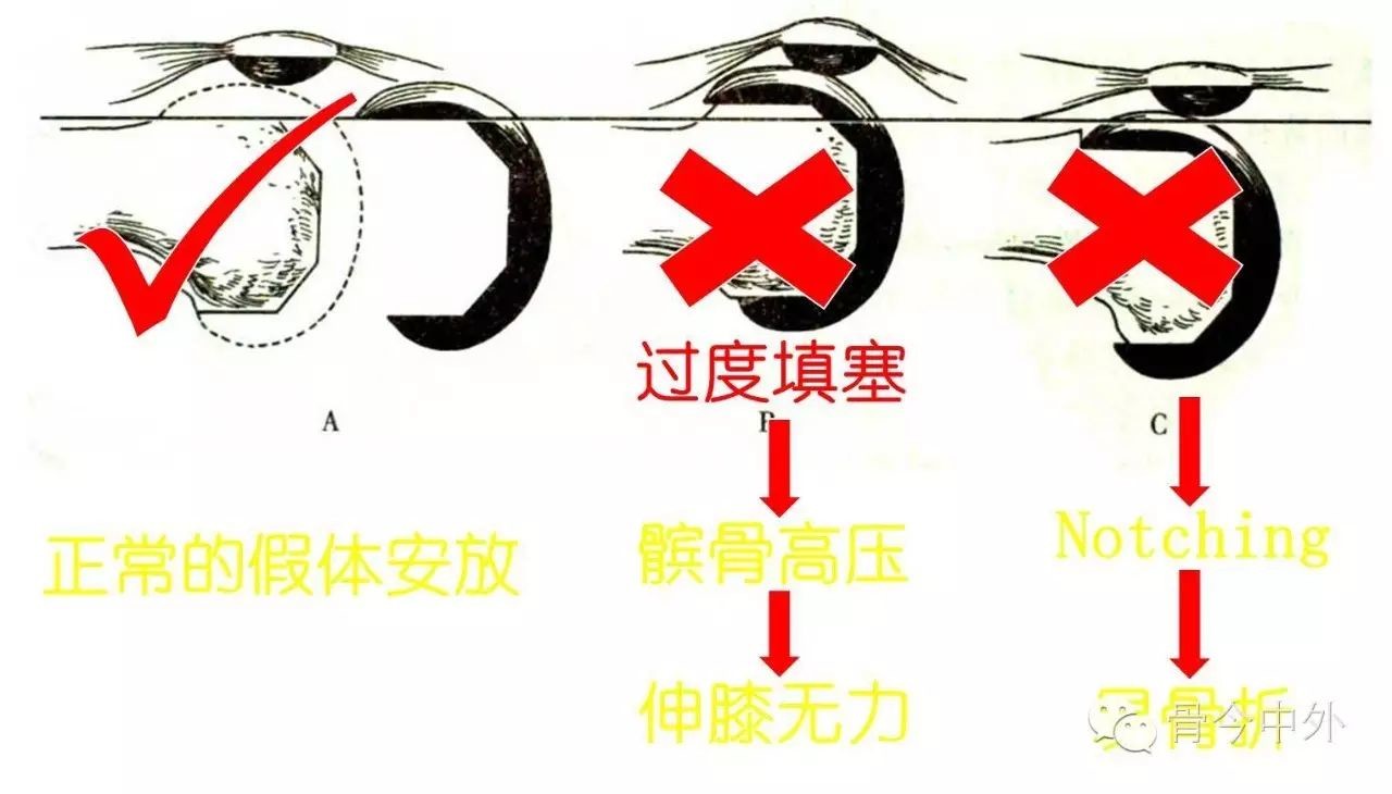 膝關節置換術後髕股關節不穩原因及應對策略_醫學界