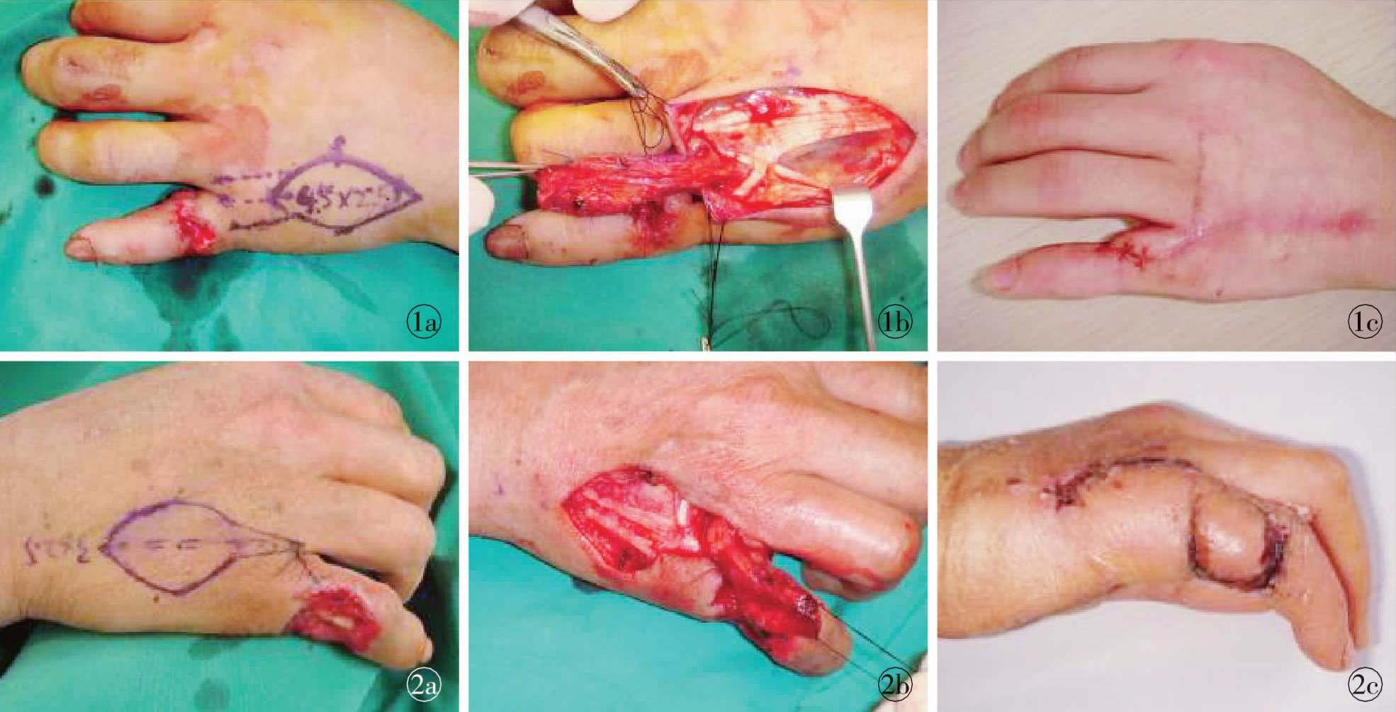 采用游离植皮往往难以成活,而且,植皮后期可因挛缩影响手指功能
