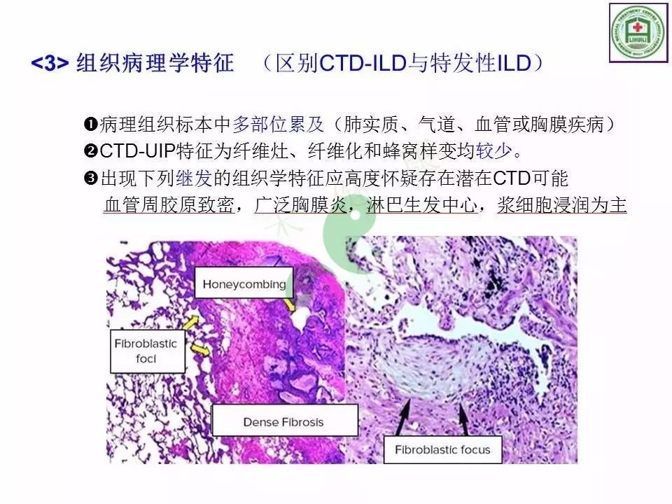 结缔组织病相关肺间质病变如何诊断？
