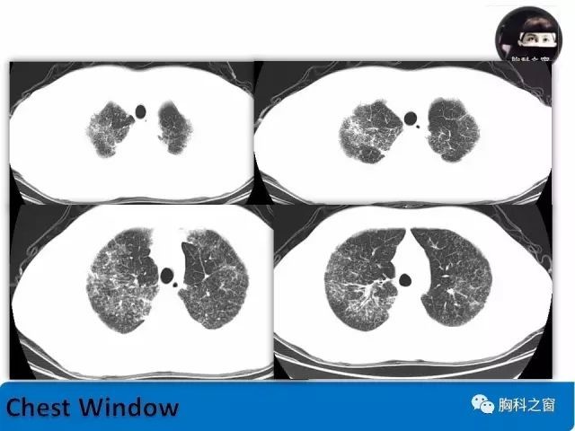病例分析肺结节病