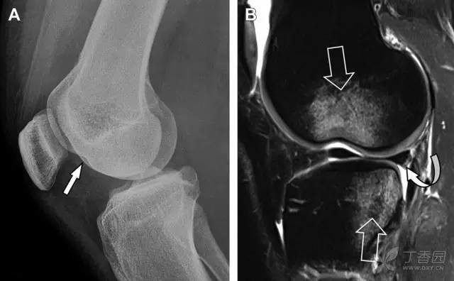 火眼金睛 这8种膝关节骨折千万别漏诊 医学界 助力医生临床决策和职业成长