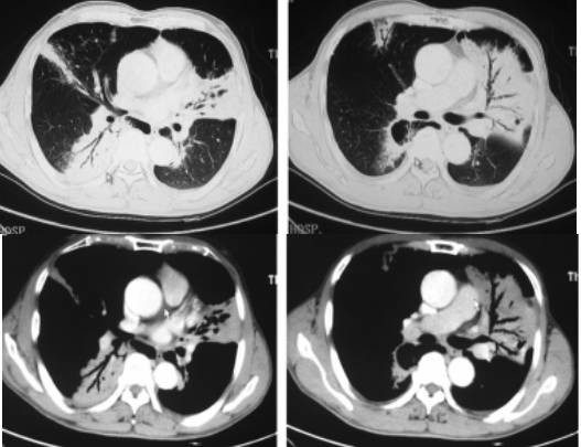 原发性肺淋巴瘤的影像诊断,你掌握了吗?
