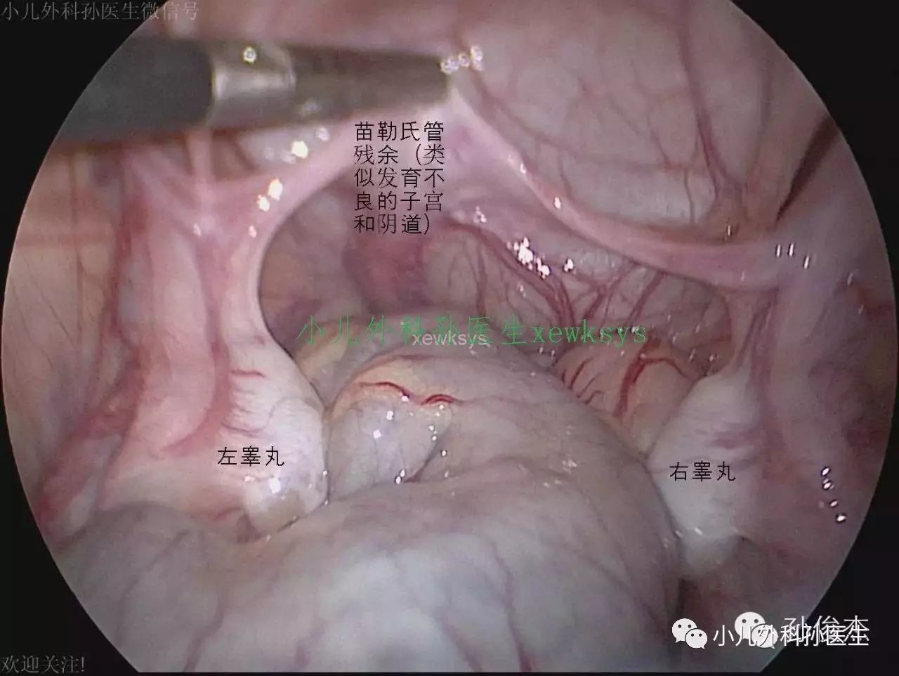 那些摸不到睾丸的隐睾 究竟会以怎样的方式隐藏 医学界 助力医生临床决策和职业成长