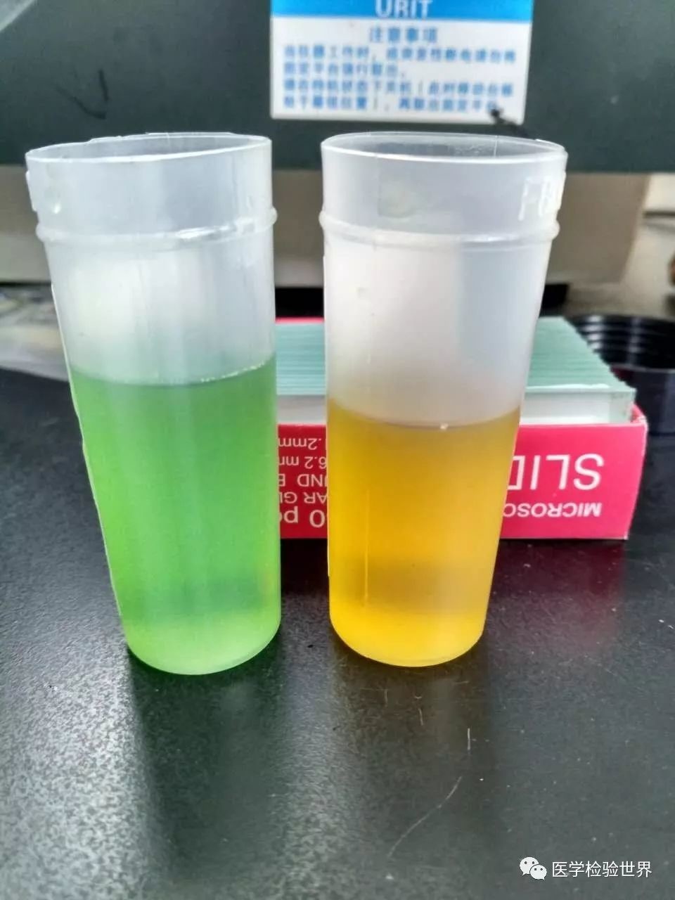 尿液颜色是怪怪的绿色（蓝色？），怪不得家属捉急！安慰了他几句，便开始了一天的工作。遇到这种标本，凭经