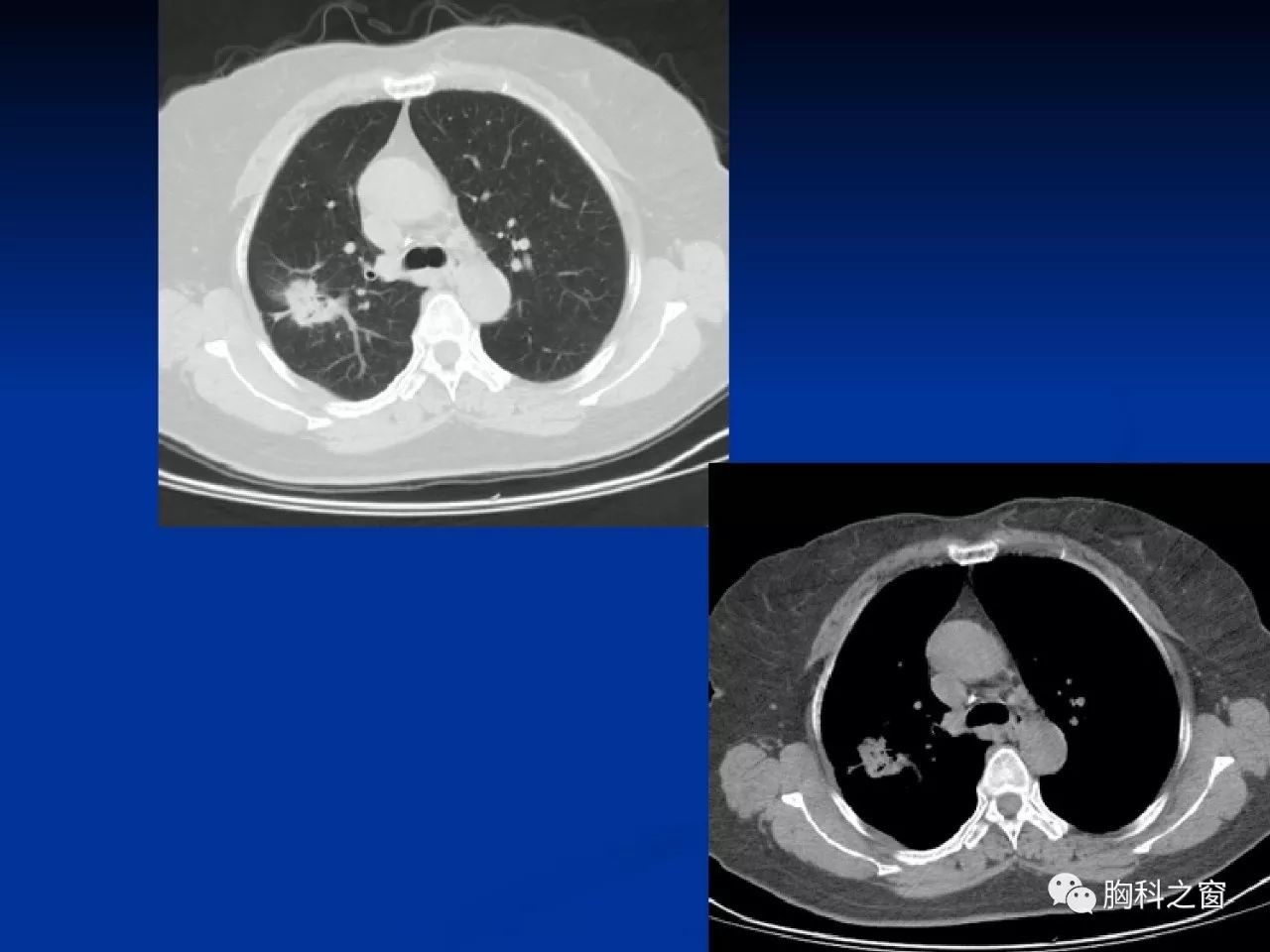 周新华:肺结核与肺癌的影像特点与鉴别_医学界-助力医生临床决策和