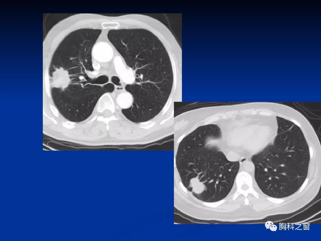周新华:肺结核与肺癌的影像特点与鉴别