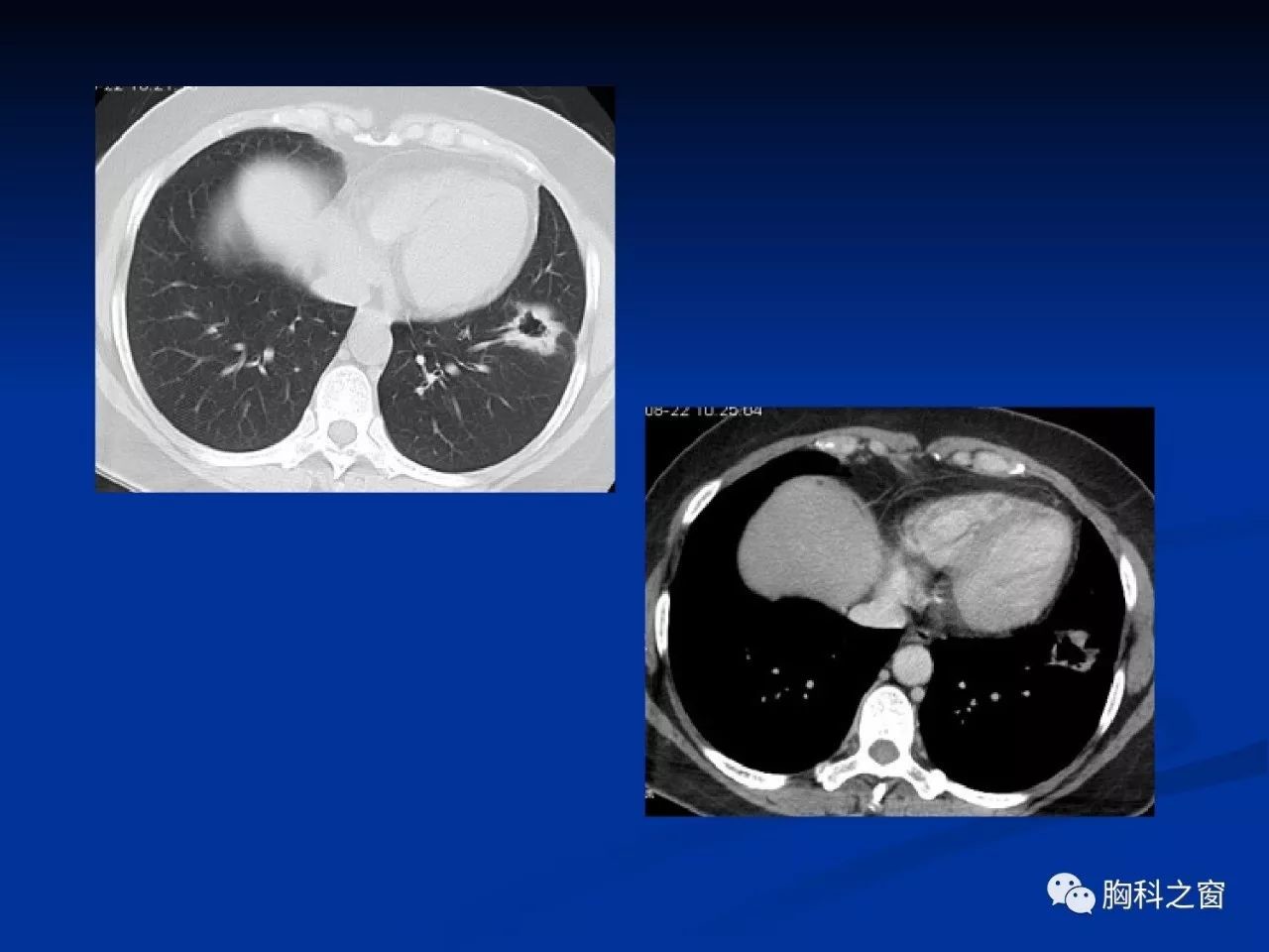 周新华:肺结核与肺癌的影像特点与鉴别