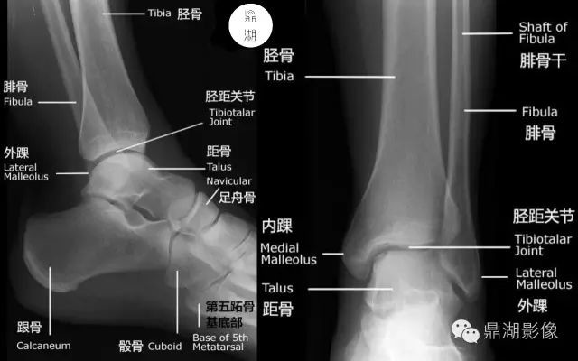 详细的踝关节X线解剖+变异+解读+测量_医学界-助力医生临床决策和职业成长
