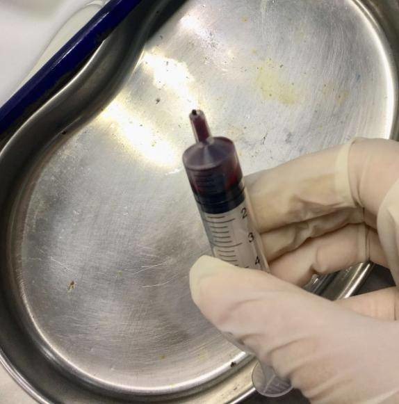 冲封管要留心:回血颜色加深或为血栓形成!