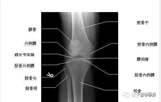 xo型腿骨骼拍片图解图片