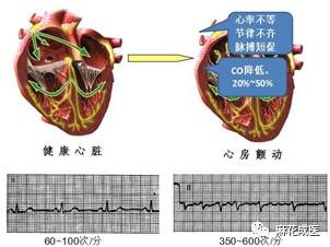 心房纤颤患者的麻醉管理