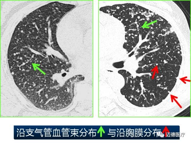 风湿科医生必备 : 肺间质改变的基本ct表现