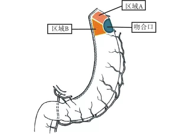 针对上述现象,我们提出一个假设:图 1 为细管状胃加端侧吻合的示意图.