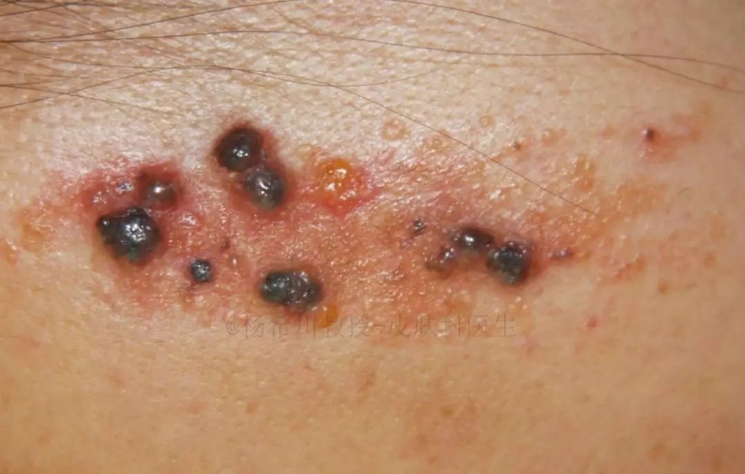 皮脂腺痣:一种可继发肿瘤的胎记