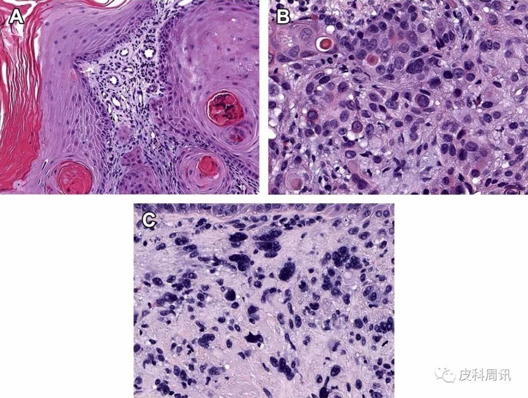 综述】皮肤鳞状细胞癌（一）_医学界-助力医生临床决策和职业成长