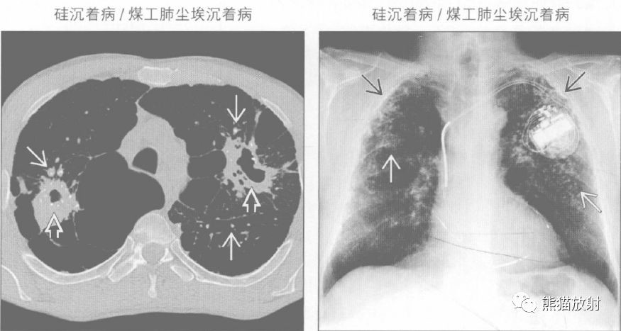 结核性胸膜炎钙化图片