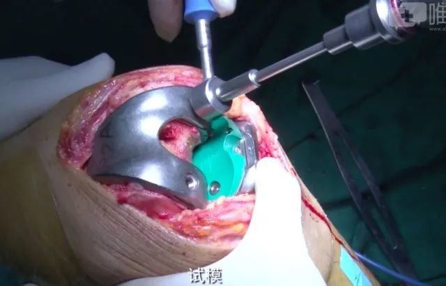 学习视频:全膝关节置换术(cr)_医学界-助力医生临床决策和职业成长