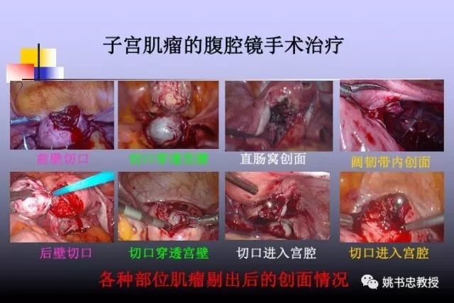 腹腔镜子宫肌瘤剔除术