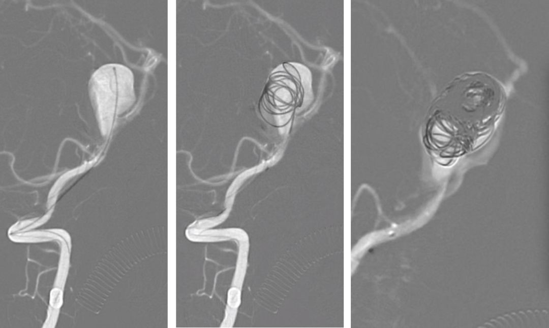 2,在泥鳅导丝导引下将5f导引导管置入左侧椎动脉v2段,synchro微导丝