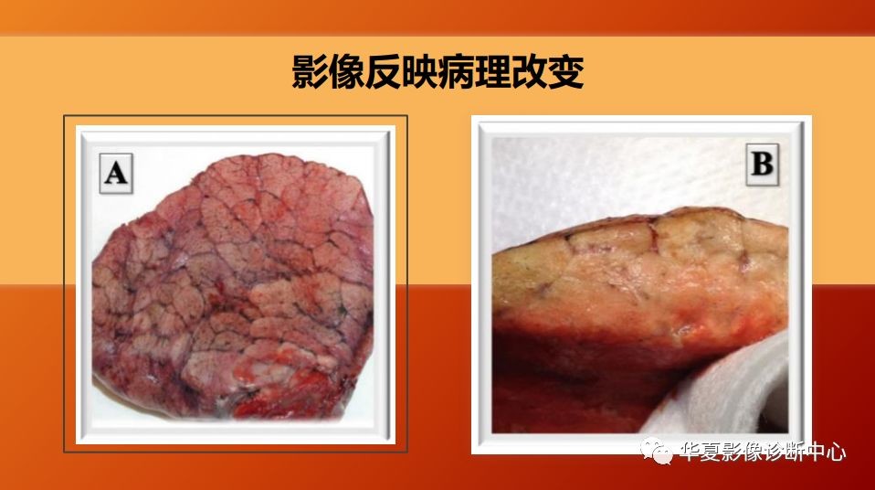 肺部弥漫性病变的良、恶性影像鉴别诊断