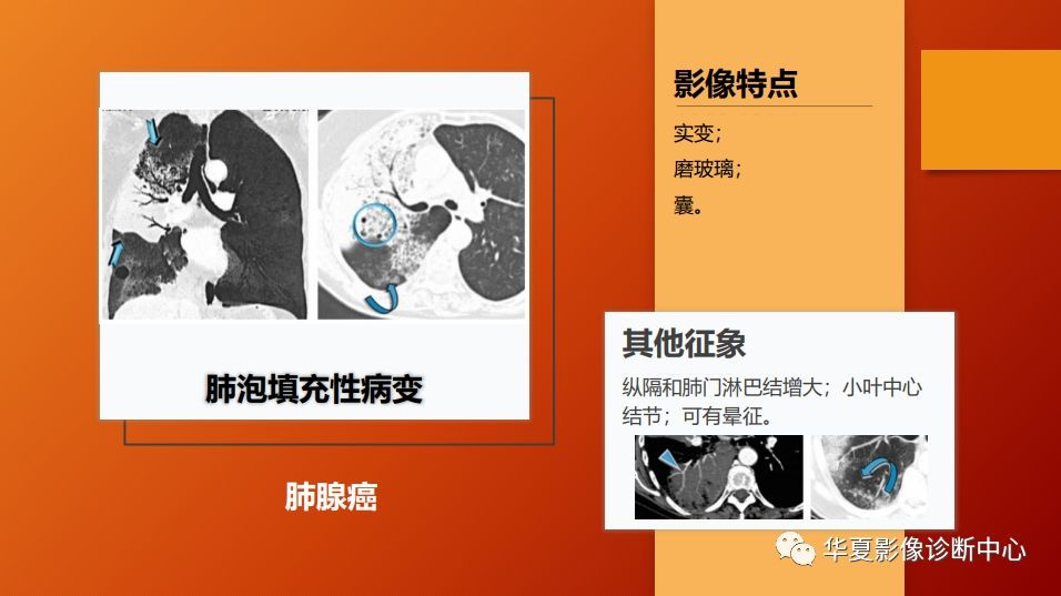 肺部弥漫性病变的良、恶性影像鉴别诊断