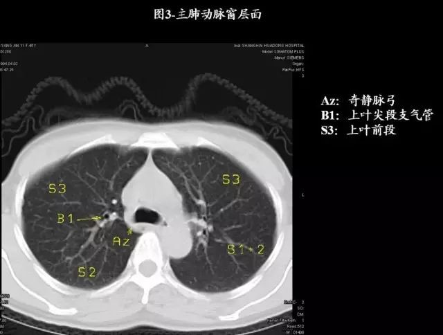 史上超全肺ct分段及典型疾病影像