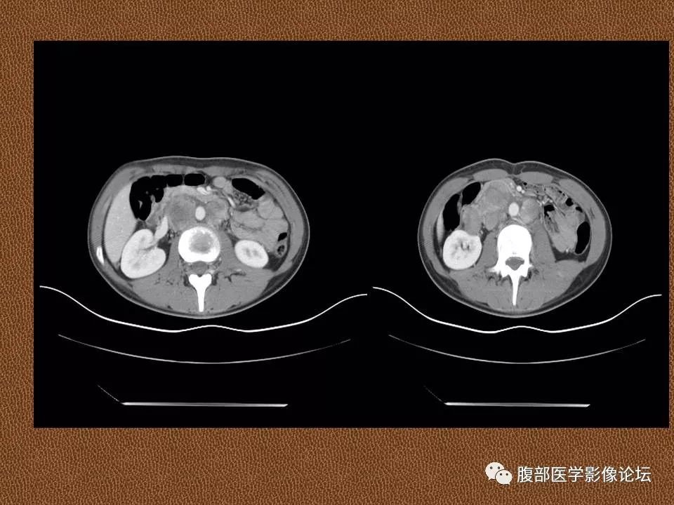 卵黄囊瘤（内胚窦瘤）