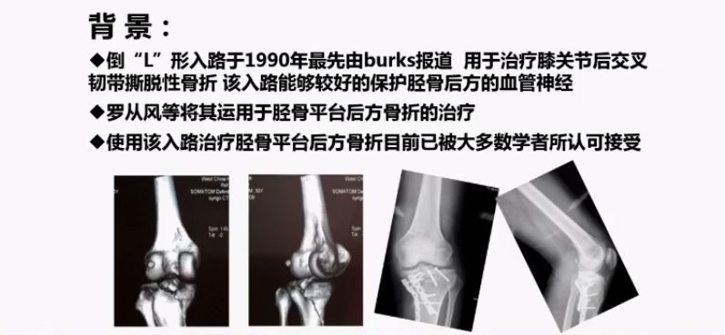 胫骨平台后外侧骨折的手术入路 后内侧倒 L 入路 医学界 助力医生临床决策和职业成长