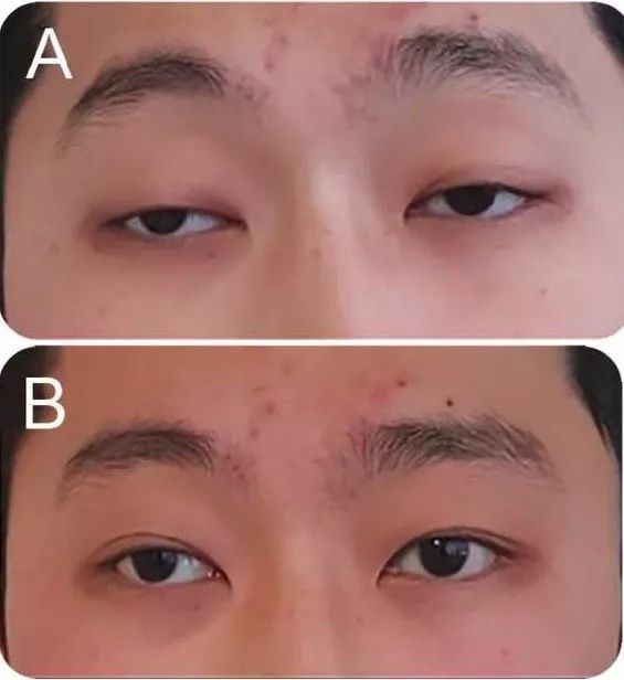 容易误诊为重症肌无力的leigh综合征_医学界-助力医生临床决策和职业