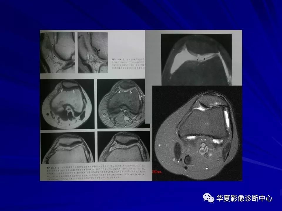 髌骨软化症详解