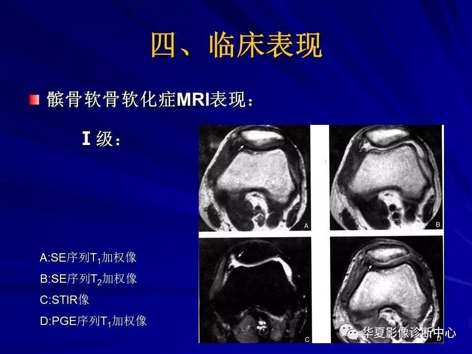 髌骨软化症详解