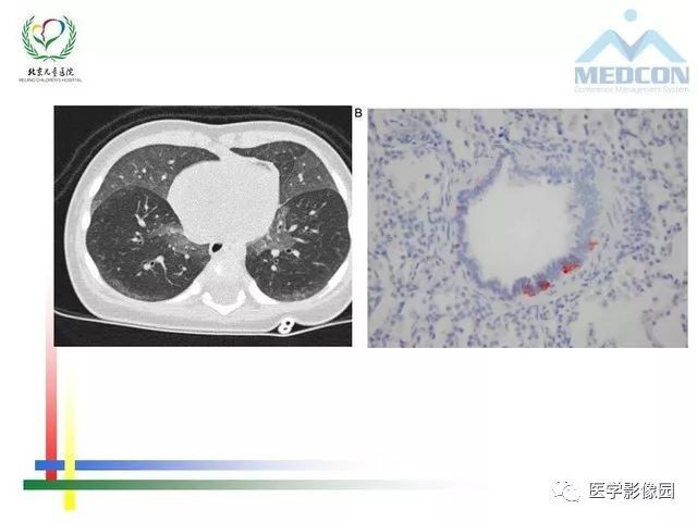 儿童间质性肺病的概念、分类和影像学 | 影像天地