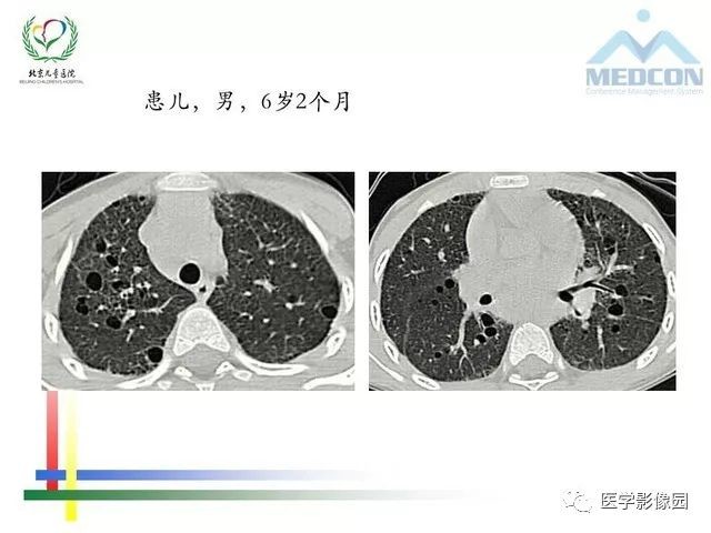 儿童间质性肺病的概念、分类和影像学 | 影像天地
