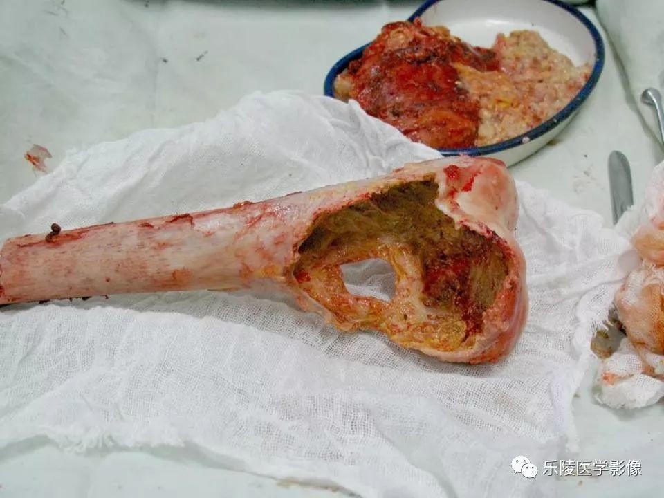 骨肿瘤及肿瘤样病变影像诊断分析