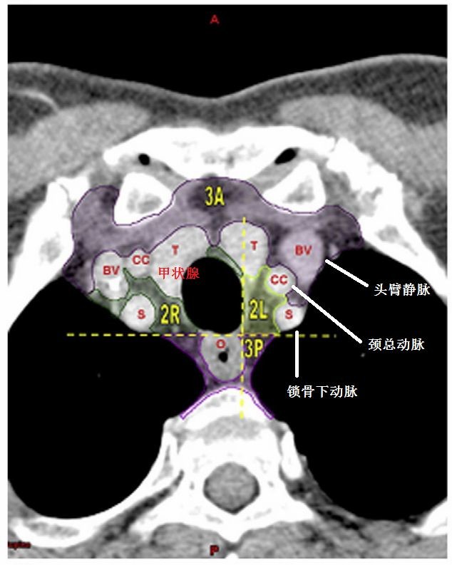 縱膈淋巴結:最新分組方法,最經典圖譜_醫學界-助力醫生臨床決策和職業