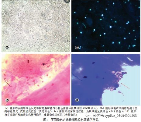 荧光染色pas染色和美蓝染色在马拉色菌毛囊炎诊断的比较